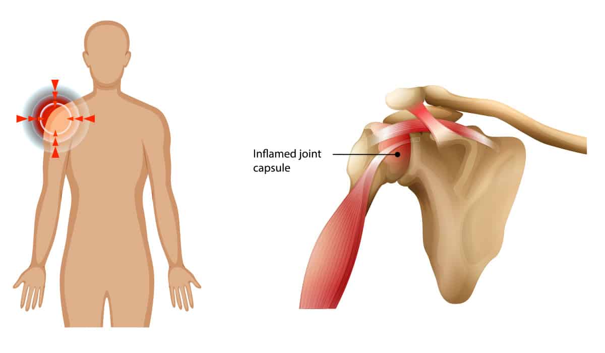 Frozen Shoulder (Adhesive Capsulitis)