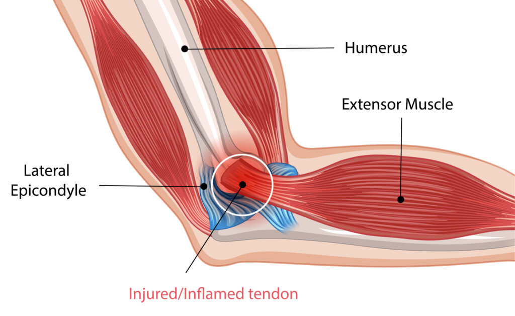 Posisi tennis elbow atau lateral epicondilytis