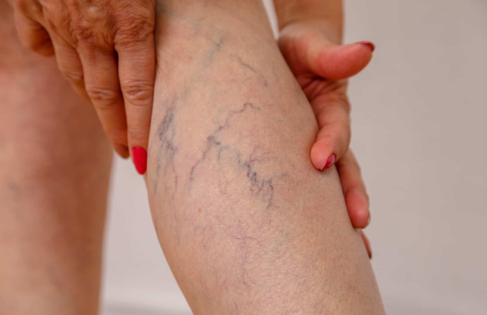 Waspada Trombosis Vena Dalam (DVT): Kenali Gejala dan Cara Mencegahnya