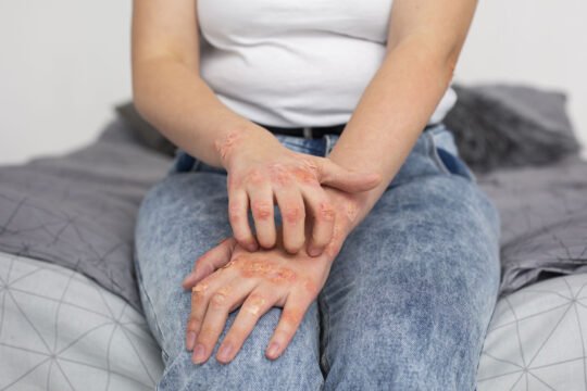 Ini Psorisis Arthritis Bukan Dikutuk Ular!