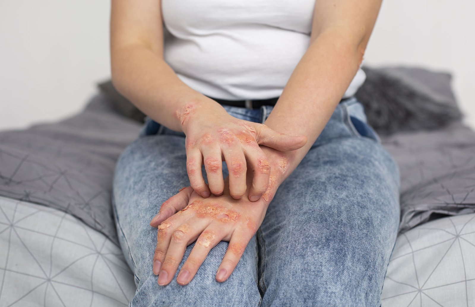 Ini Psorisis Arthritis Bukan Dikutuk Ular!