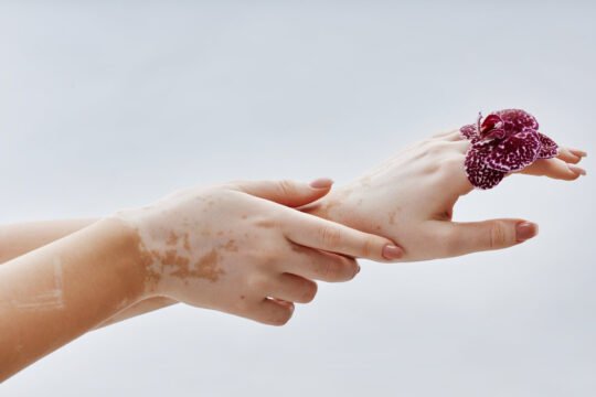 Benarkah Lagu Michael Jackson: Black or White Tercipta Karena Vitiligo yang Dialaminya?