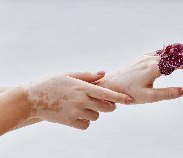 Benarkah Lagu Michael Jackson: Black or White Tercipta Karena Vitiligo yang Dialaminya?