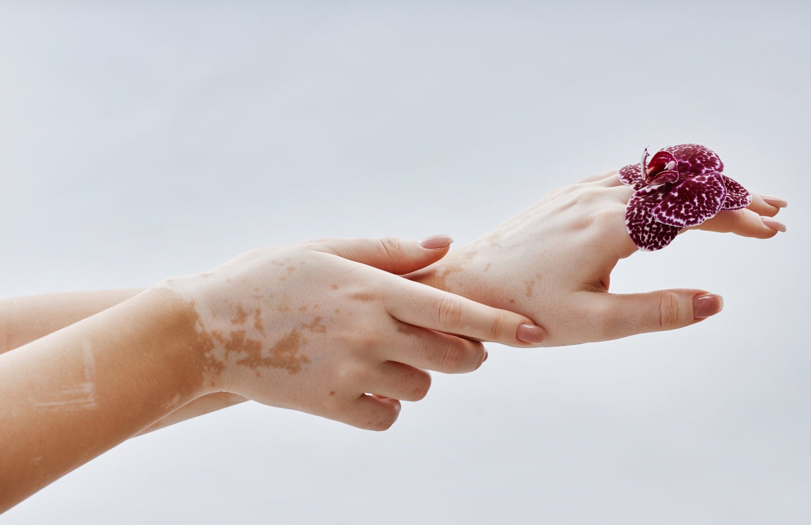 Benarkah Lagu Michael Jackson: Black or White Tercipta Karena Vitiligo yang Dialaminya?